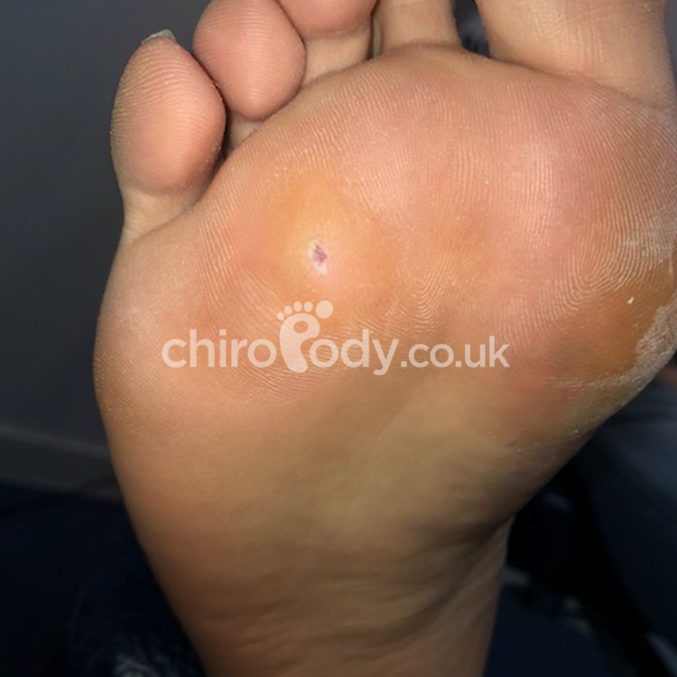 hard skin on big toe removal